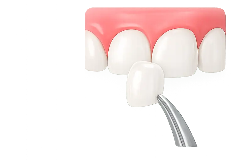 Veneer Gigi